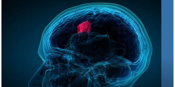 What is a Brain Tumor and How Does it Affect the Body?